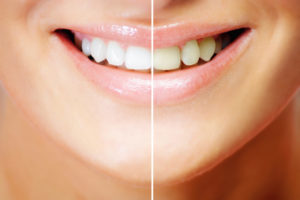 professional in-office teeth whitening before and after